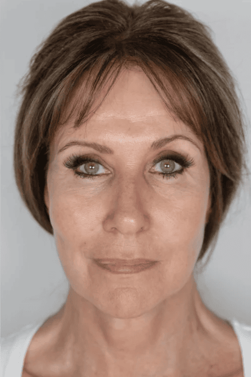 After NeoGen Plasma Skin Regeneration treatment