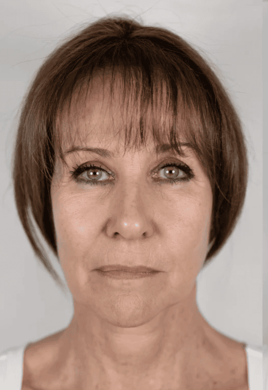Before NeoGen Plasma Skin Regeneration treatment