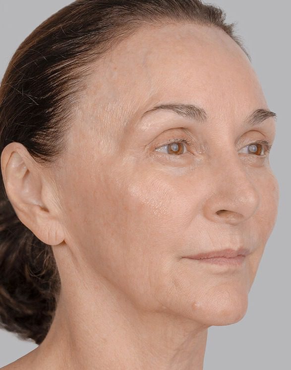 Regenerative skin treatments