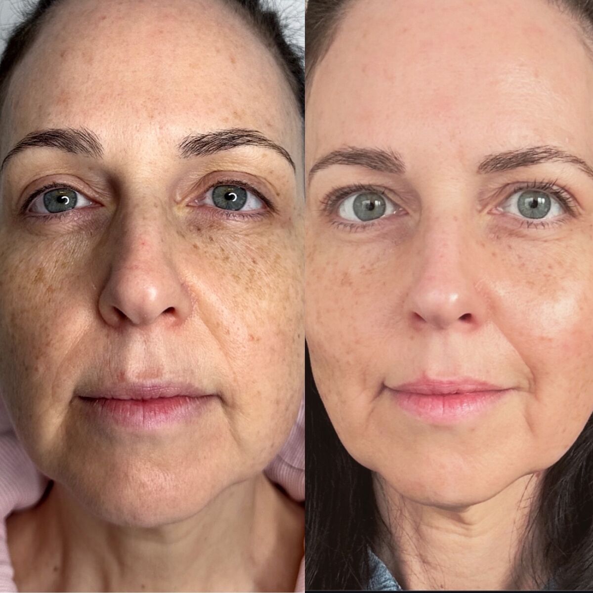neogen treatment results